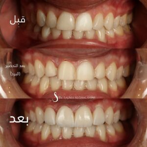 قبل وبعد 13