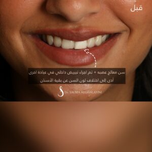 قبل وبعد 14
