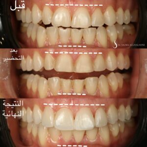 قبل وبعد 5